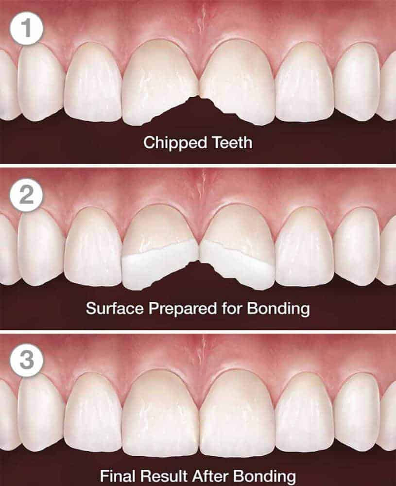 composite restoration