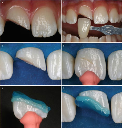 composite restoration