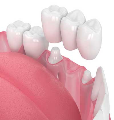 dental implant in Jaipur