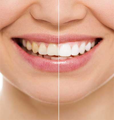 dental bleaching