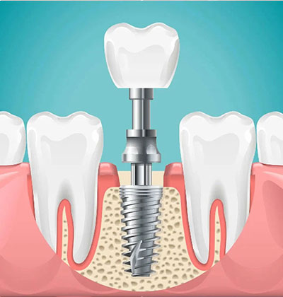 dental implant in Jaipur