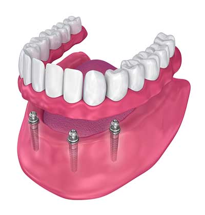 fixed denture