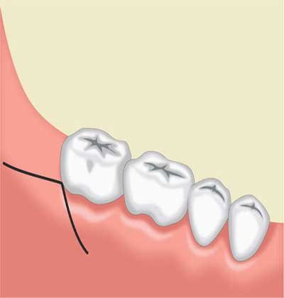Dental Flap Surgery