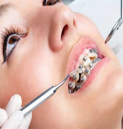 Orthodontic Braces