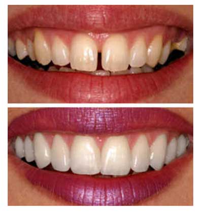 Smile Designing and Cosmetic Dentistry